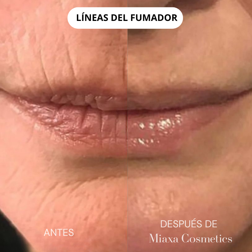 Kit de Microinfusión Miaxa™ Solución Antiedad