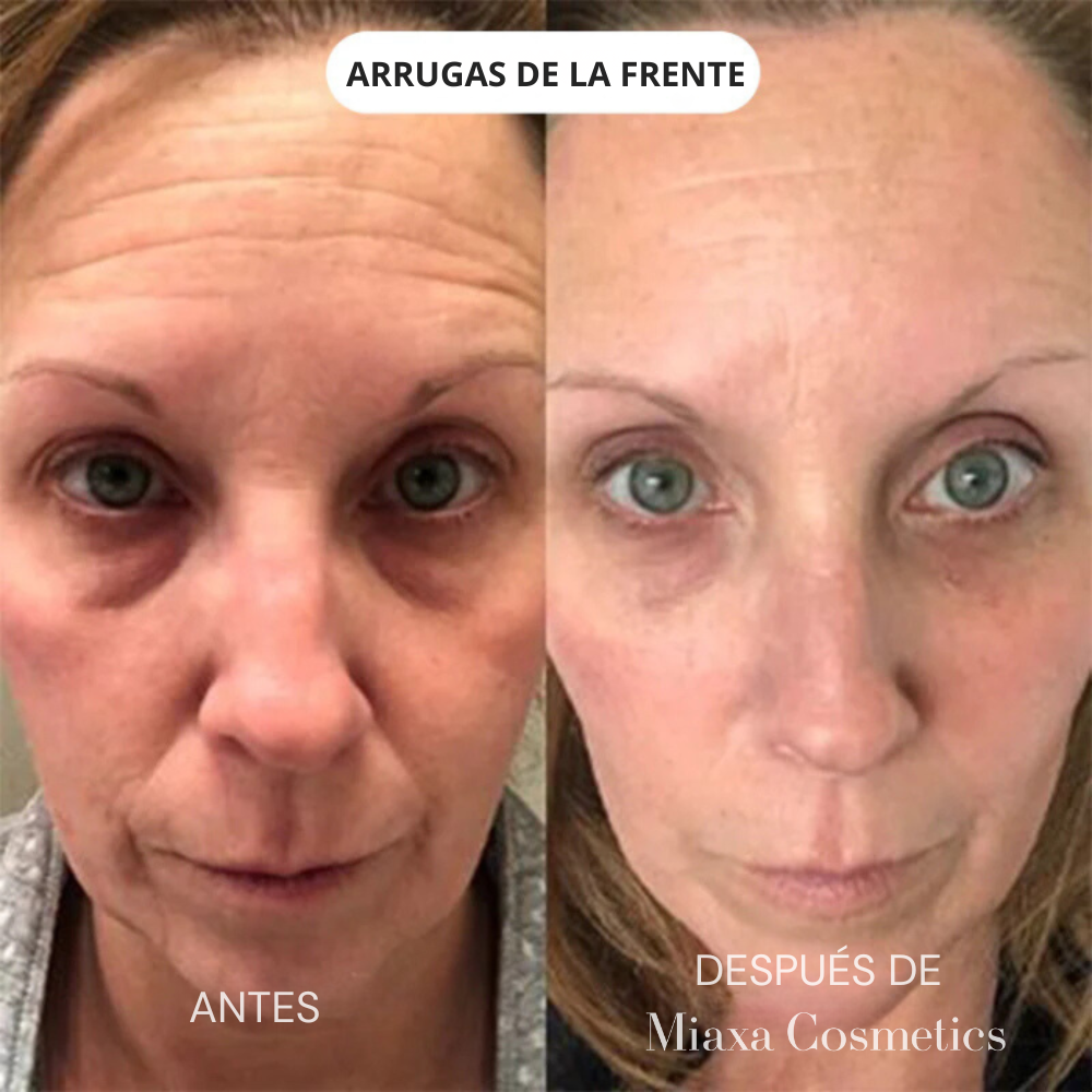 Kit de Microinfusión Miaxa™ Solución Antiedad