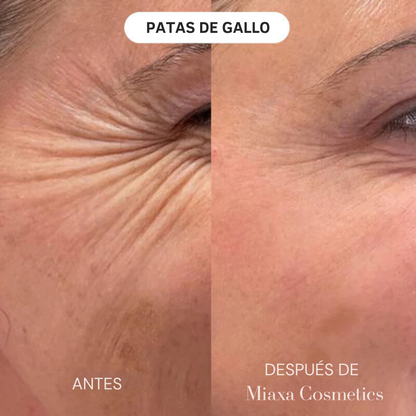 Kit de Microinfusión Miaxa™ Solución Antiedad