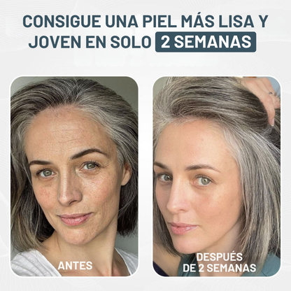 Kit de Microinfusión Miaxa™ Solución Antiedad