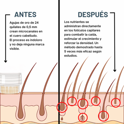 Kit de Microinfusión Miaxa™ Solución Capilar