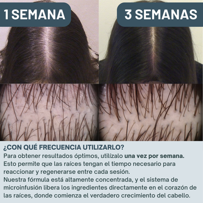 Kit de Microinfusión Miaxa™ Solución Capilar