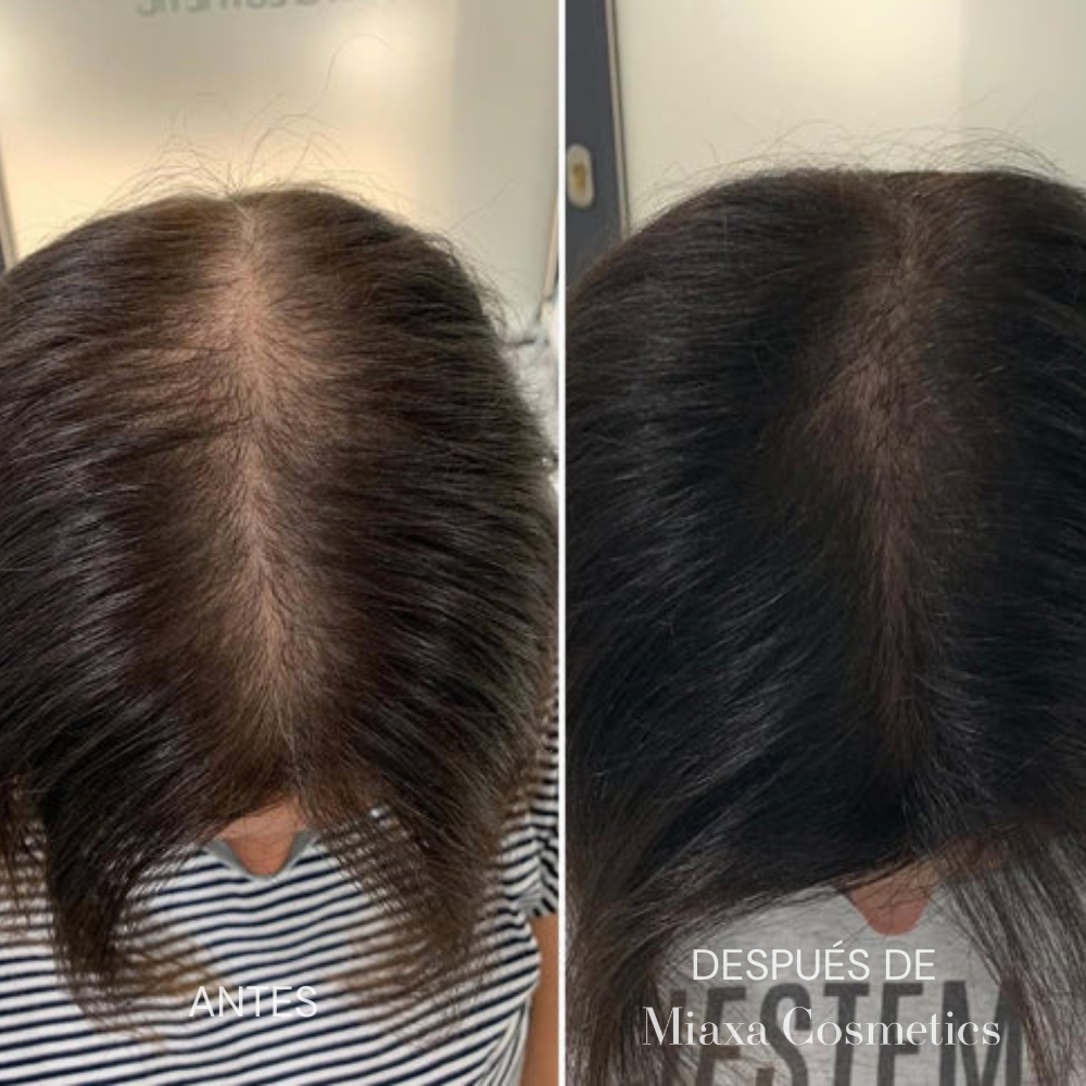 Kit de Microinfusión Miaxa™ Solución Capilar