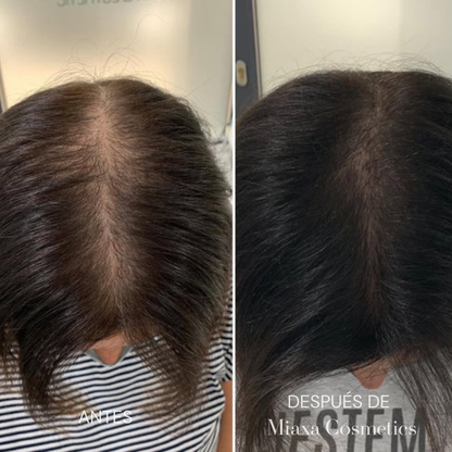 Kit de Microinfusión Miaxa™ Solución Capilar