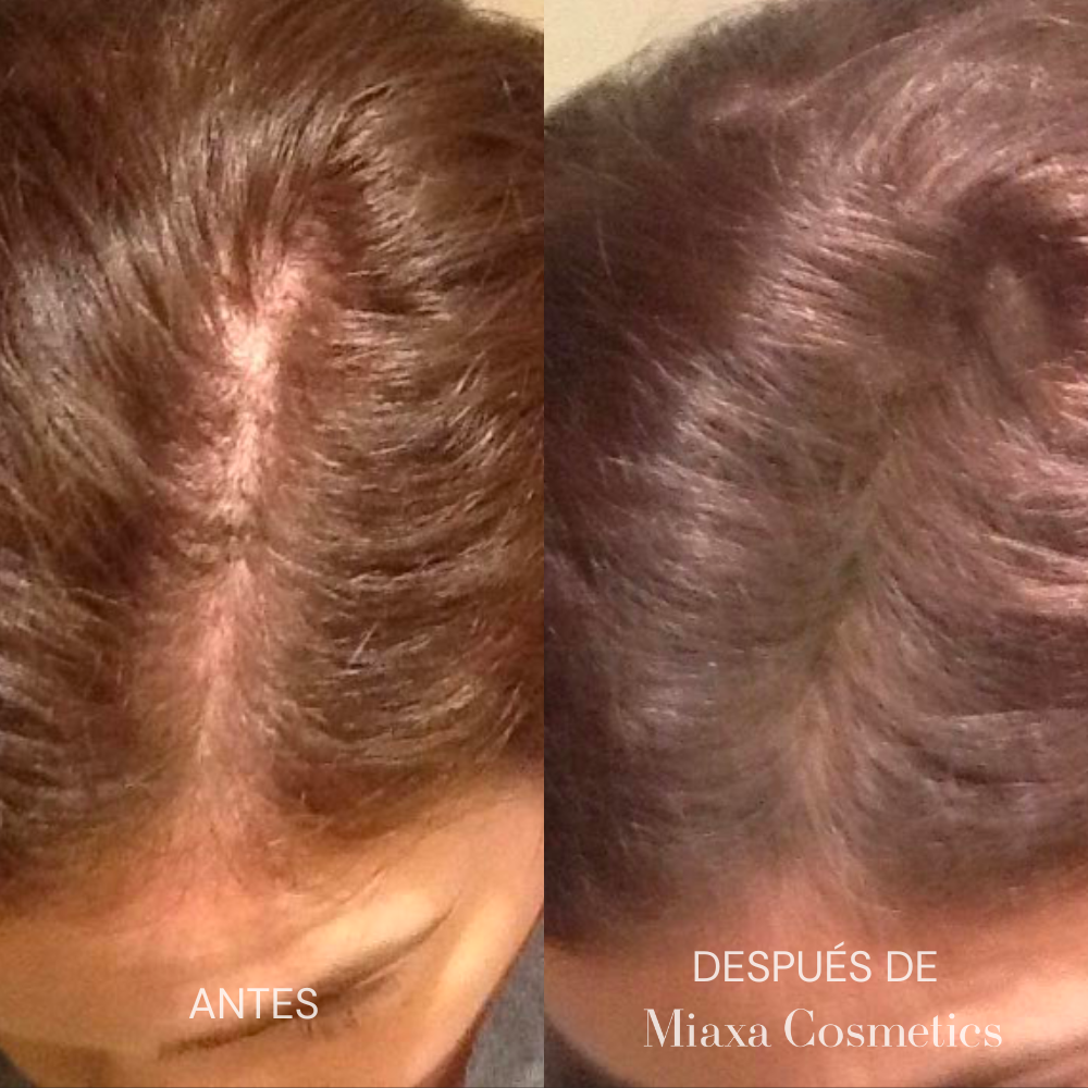 Kit de Microinfusión Miaxa™ Solución Capilar