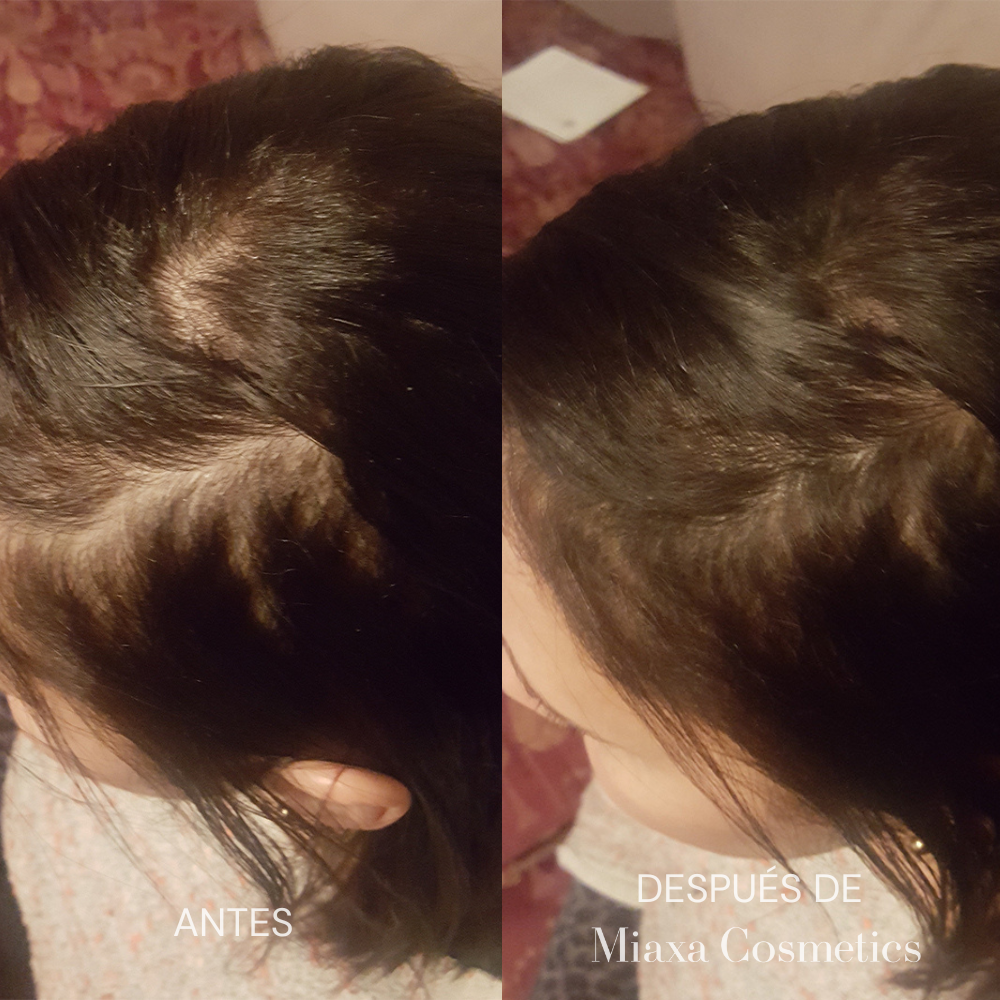 Kit de Microinfusión Miaxa™ Solución Capilar